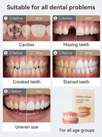 Premium All-Inclusive Full Dentures, No Dentist Required, Regain Your Confidence
